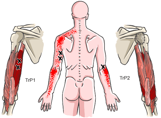 Triggerpoint triceps brachii